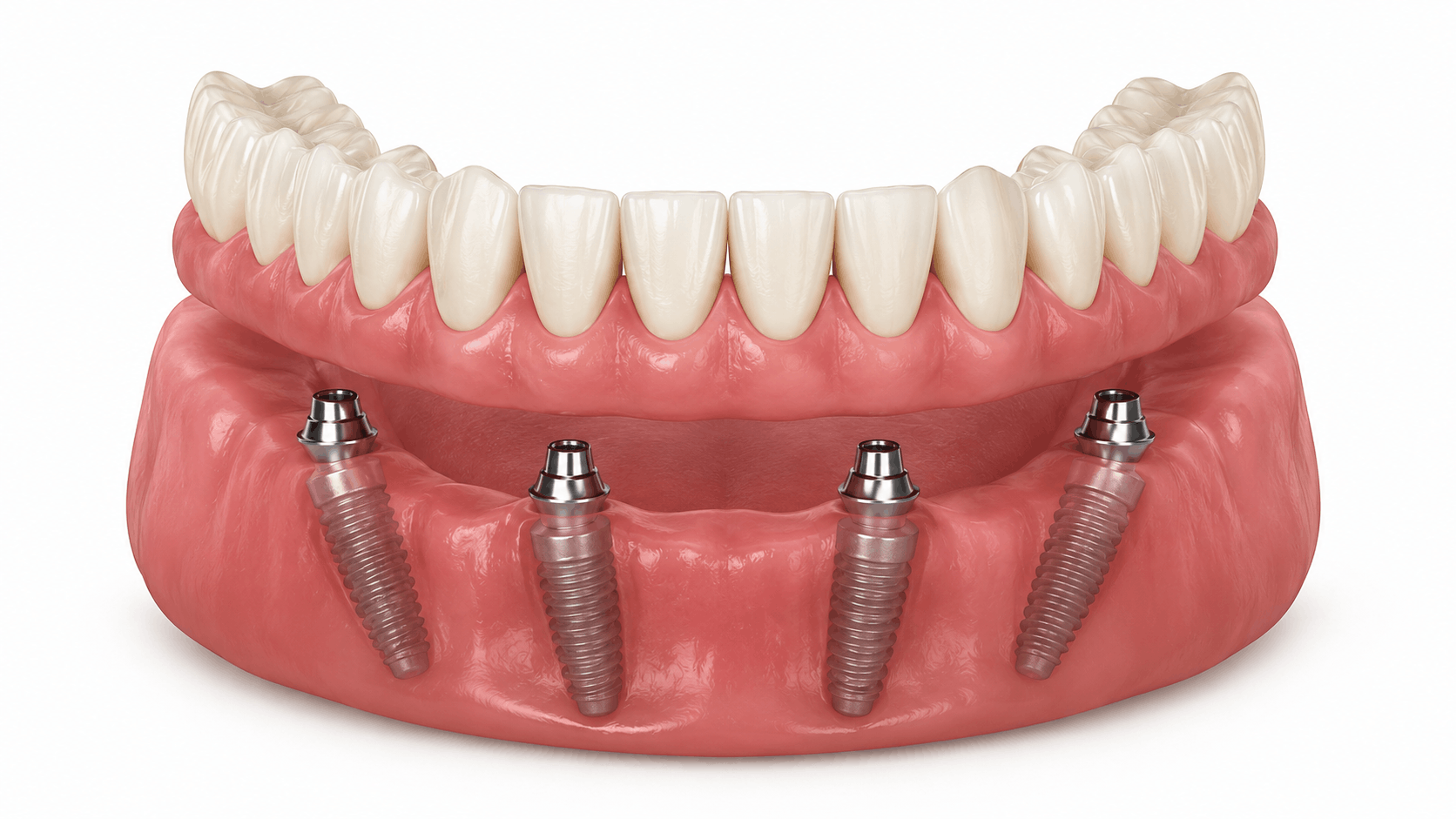 All On 4 Implants