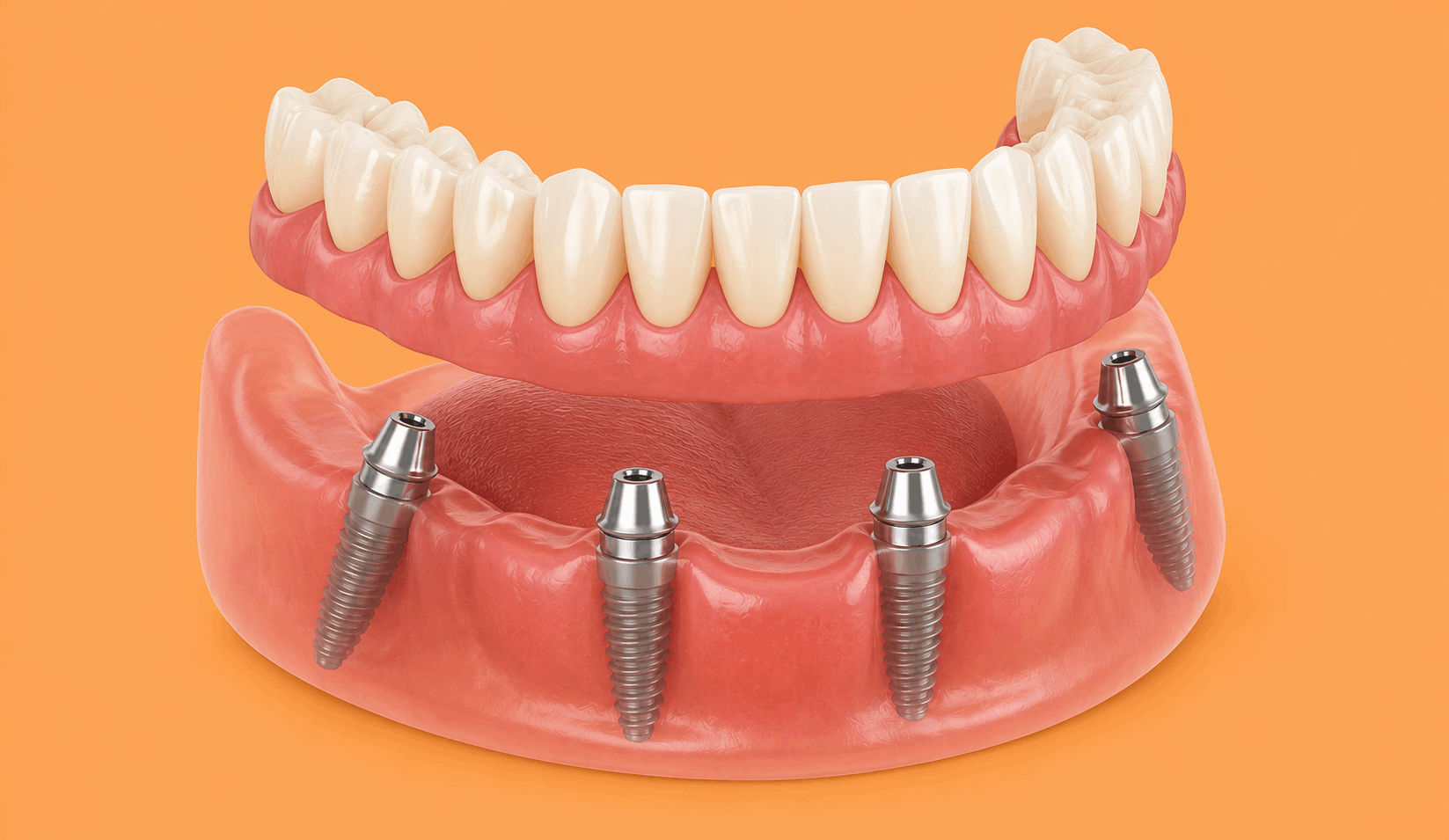 Full Arch Restoration With All On 4 Implants On The Gold Coast