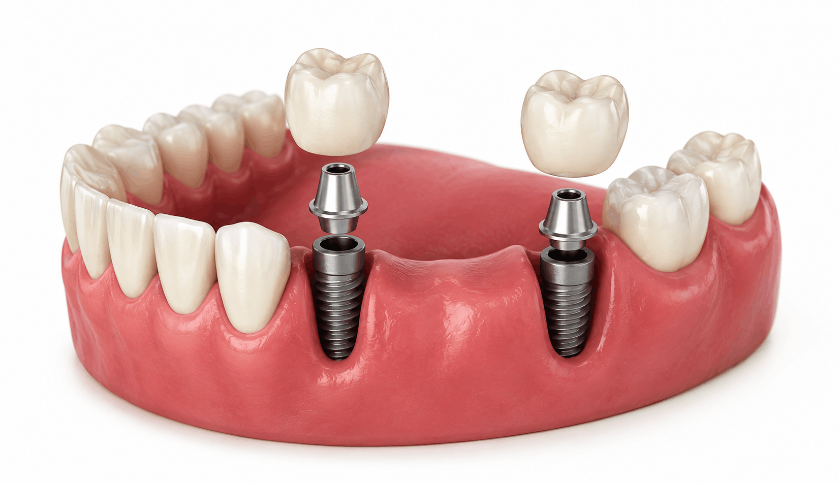 Traditional Implants