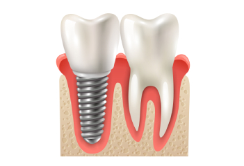 Dental Implant