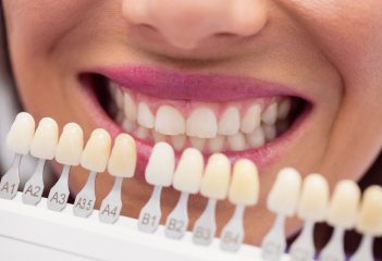 Veneers