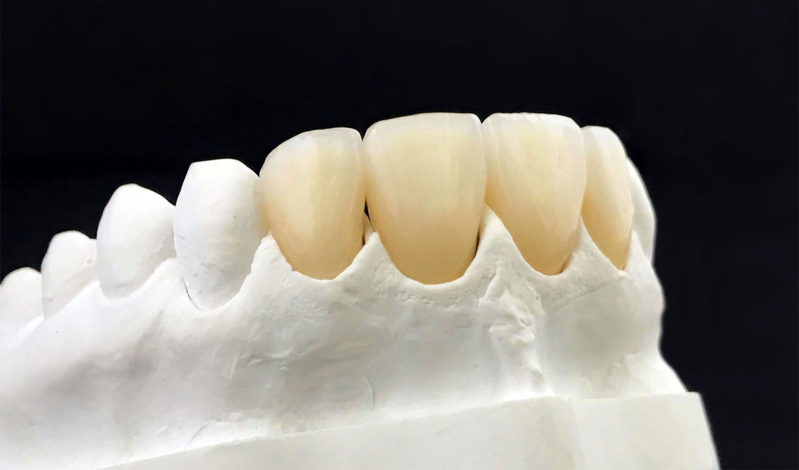 Zirconia Dental Crown Sunshine Boulevard Dental