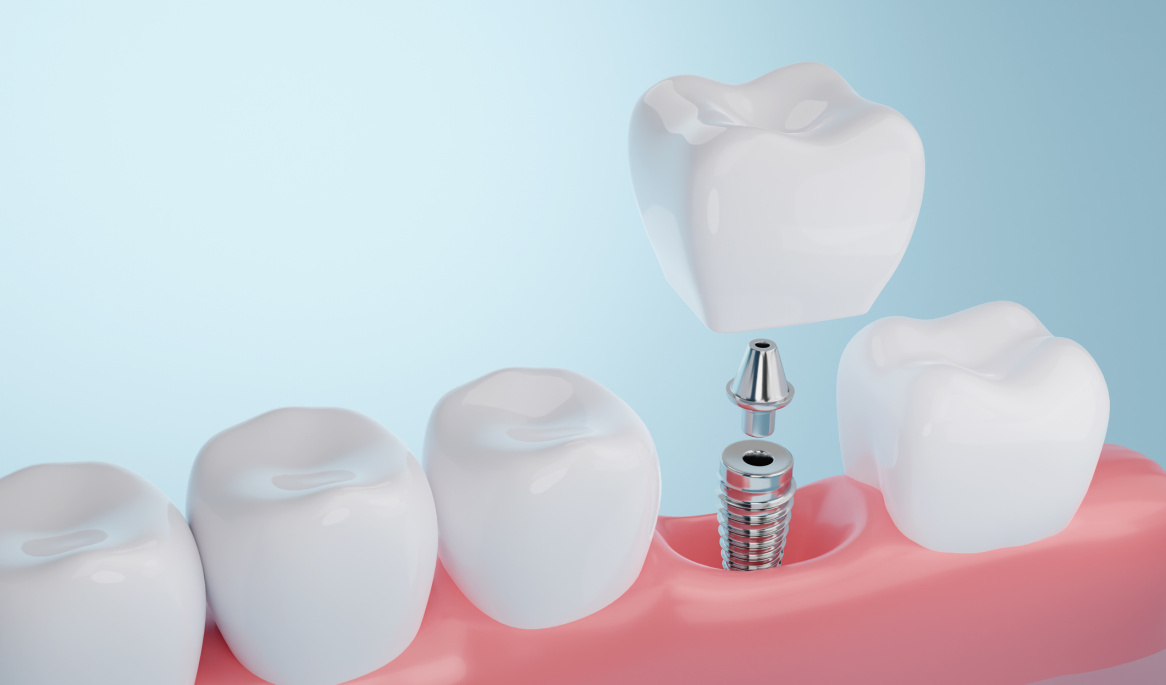 Dental Implant